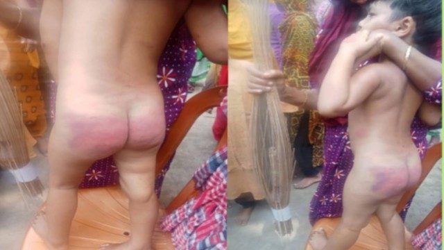 কিশোরগঞ্জে নির্যাতনে জর্জরিত শিশু সোহা মনি, পলাতক সৎ মা